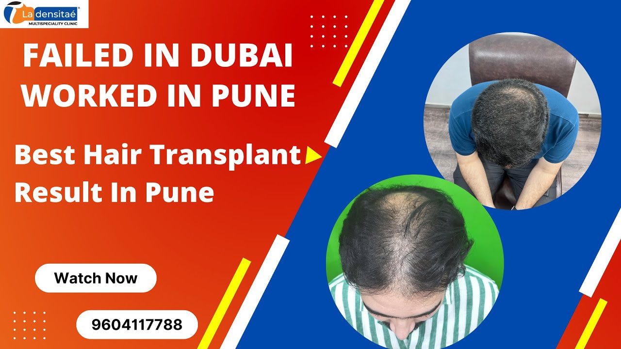 Best Hair Transplant in Pune|| Best Hair...