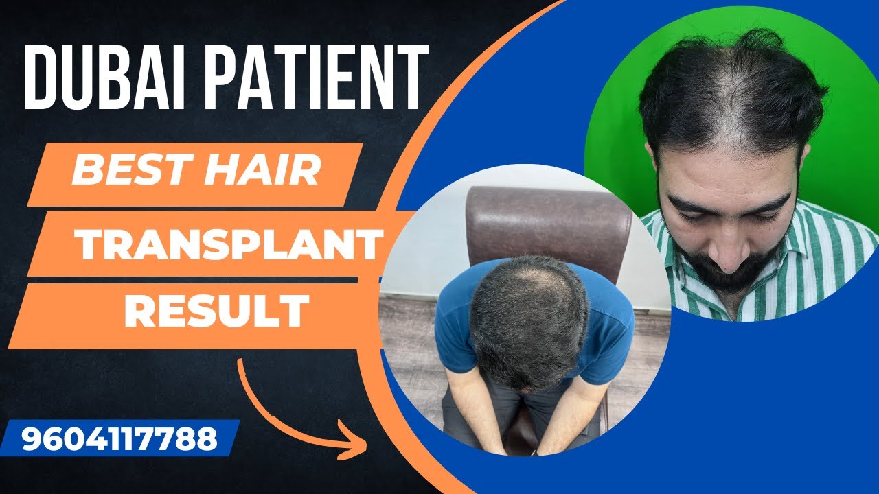 Dubai Patient's Hair Transplant in Pun...